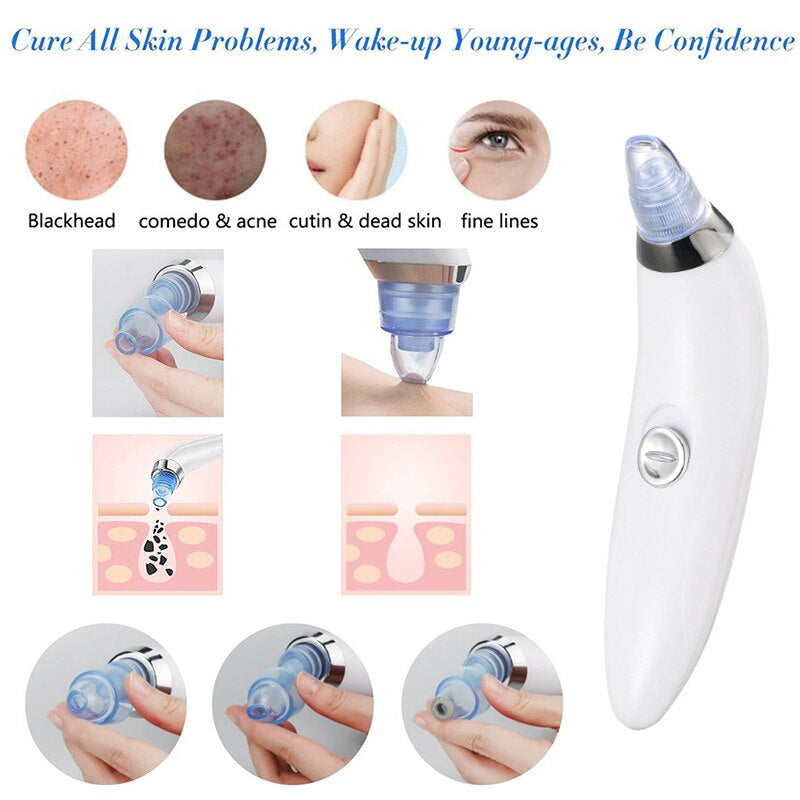 Professional Blackhead & Whitehead Remover